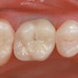 Dental crown by Dental Associates, Inc.