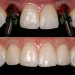 Dental veneers by Dental Associates, Inc.